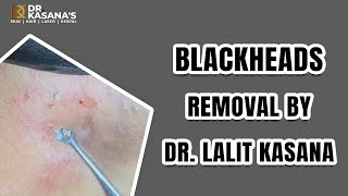 Blackhead removal Dr Lalit kasana  blackhead removal on face This week 2022 [upl. by Blatman]