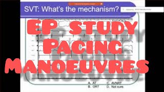 Pacing manoeuvers for SVT EPpacing pacingmanoeuvers epstudy Ablation drnarendrakumar [upl. by Notgnimer149]