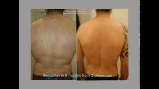 Male back clearance by electrolysis [upl. by Dayna]