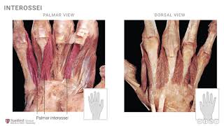 Anatomy of the Upper Limb Interossei and Lumbricals [upl. by Louis]