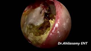 L Sec Cholesteatoma with CP with Auto mastoidectomy cavity  Endoscopic Tympanoplasty under LA [upl. by Clova]