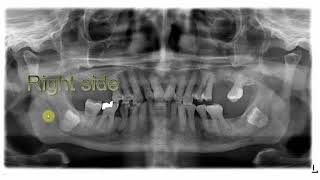 OPG Signs of close 3rd molar apex to ID canal [upl. by Nitaj883]