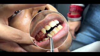 How to Treat Posterior Crossbite Using Rapid Palatal Expansion RPE [upl. by Mountford12]