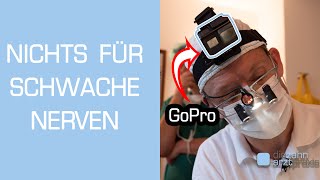 Zahnarzt filmt Weisheitszahn OP mit GoPro Vollnarkose [upl. by Philina]