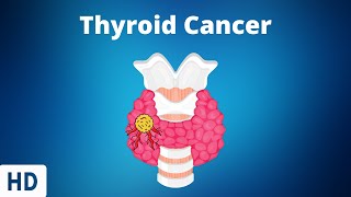 Thyroid Cancer Everything You Need to Know [upl. by Christalle132]