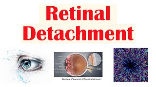 Retinal Detachment  Types Risk Factors Pathophysiology Signs amp Symptoms Diagnosis Treatment [upl. by Nebuer]