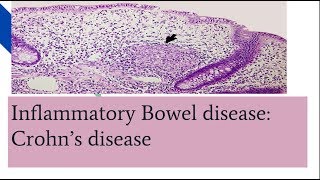 Understanding Fistulizing Crohns Disease [upl. by Heigho]