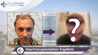 Haarimplantation Ergebnisse Vorher Nachher [upl. by Shulem]