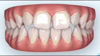 Jugendliche offener Biss Beispiel InvisalignR Zahnspange durchsichtig [upl. by Eivod]
