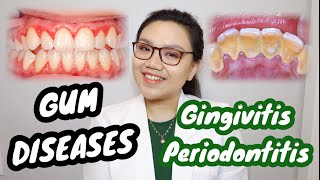 GUM DISEASE Gingivitis and Periodontitis 🦷 Namamagang gilagid masama ba  Dr Bianca Beley [upl. by Mcdonald]