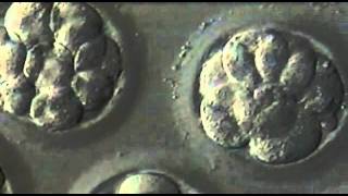 5Day Blastocyst Transfer [upl. by Zaccaria]