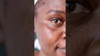 Syringoma removal at Derma skin clinic skincare skincareroutine mydermatfordarkspots [upl. by Arretal]