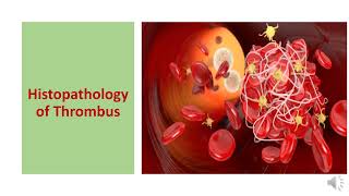 THROMBOSIS TYPES  HISTOPATHOLOGY CONSEQUENCES DIAGNOSIS AND PREVENTION [upl. by Nerhe]