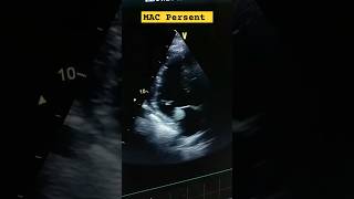 Global LV hypokinesia Severe LV Dysfunction Moderate Aortic stenosis MAC hferf heartfailure [upl. by Eiramana871]