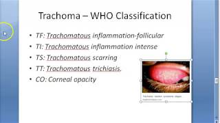 Ophthalmology 076 d Trachoma WHO Classification FISTO [upl. by Pepito]