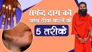 सफेद दाग White Spots को जल्द ठीक करने के 5 तरीके  Swami Ramdev [upl. by Alessig974]