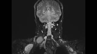 Neurofibromatosis [upl. by Murray]