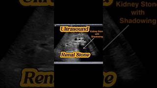 Renal Stones  Ureteric VUJ Stone  Hydronephrosis Hydroureter Ultrasound [upl. by Sil]