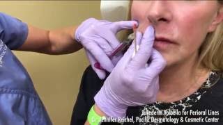 Juvederm Volbella Demo for Perioral Lines around the lips  2068595777 [upl. by Annaoy982]