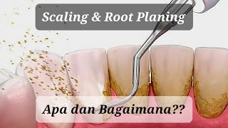 Scaling amp Root Planing  Upaya Mempertahankan Gigi [upl. by Ozmo]