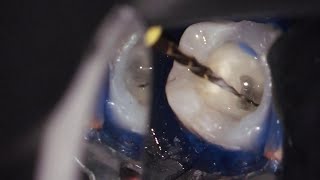 Endodontic in Ramadan  الحلقة الأولي  Diagnosis  part 1 [upl. by Mello]