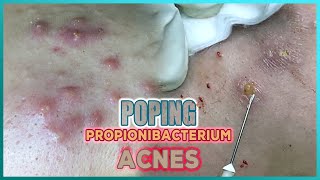 Big Cystic Acne Blackheads Extraction Blackheads amp Milia Whiteheads Removal Pimple Popping [upl. by Yadrahc990]