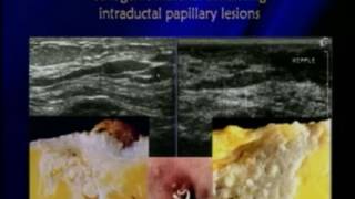 Advanced Breast Ultrasound [upl. by Satterlee516]