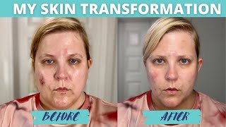 Before and After How I Dramatically Improved My Skin [upl. by Asirrac]