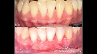 Coronally advanced flaps CAF plus connective tissue graft CTG in lower incisors [upl. by Eiryk]