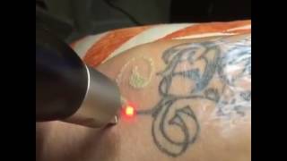 PicoSureTattooRemoval [upl. by Garth510]