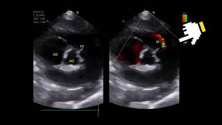 Pulmonary hypertension in an 15yearold female dog with recent syncopal episodes [upl. by Inajar]