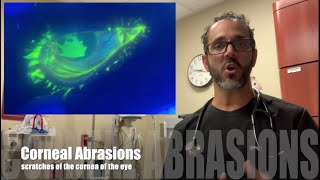 Corneal Abrasion [upl. by Mcdowell452]