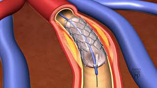 Animation  Coronary stent placement [upl. by Adnuhsor]