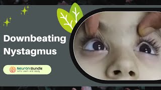 vertical eye movements  nystagmus  downbeat nystagmus nystagmus verticalnystagmus [upl. by Hershel]