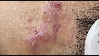 Hematoma Inflammation Acne HoangMySpa87 [upl. by Eecak69]