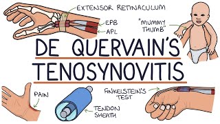 Understanding De Quervain’s Tenosynovitis Mummy Thumb [upl. by Riella821]