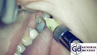 Infiltration anesthesia for extraction 26 tooth and implantation area 2526 [upl. by Rothwell]