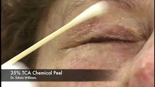 35 TCA Chemical Peel by Dr Edwin Williams for Wrinkles amp Sun Damage [upl. by Tilla104]