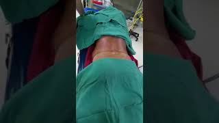 Vertebroplasty procedure  drNoman [upl. by Hanselka497]