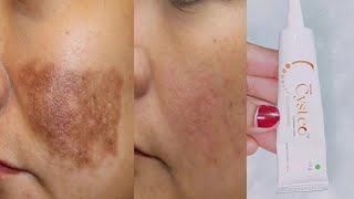 Cysteamine cream reviews for melasma  Cysteo cream how to use  Cysteo cysteamine cream [upl. by Hcra367]