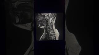 🤔Mri t2 cervical spine image c spine mriradiology viral mri shortsvideo shorts [upl. by Bora]