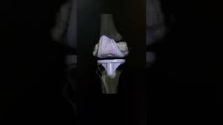 😱Knee replacement in ct VRT viewshortsradiologyviralshortsradiologicalmrikneect [upl. by Corydon]