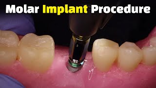 Step by Step Dental Implant Procedure  Back Molar [upl. by Eeramit]