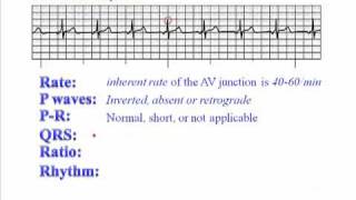 ECG Junctional Rhythm [upl. by Meneau69]