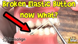 Invisalign Help  Broken Elastic Hook or Button and still want to wear your elastics  Dr Paulson [upl. by Namad549]