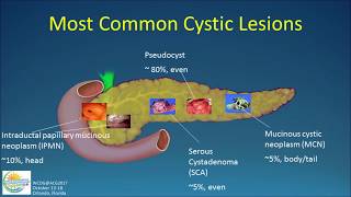 Natural History of Pancreatic Cysts What Becomes of Them [upl. by Mozza]