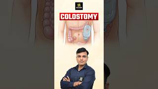 Colostomy Surgical Opening shorts utkarshnursing shailendrasir [upl. by Girish730]