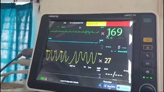 Tachypnoea in severe mitral stenosis with atrial fibrillation and fast ventricular rate [upl. by Esirehs]