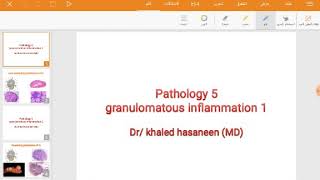 Non caseating granuloma of LN [upl. by Hailat532]