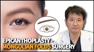 Epicanthoplasty  Eye Surgery that modifies the Epicanthal Folds [upl. by Leupold]